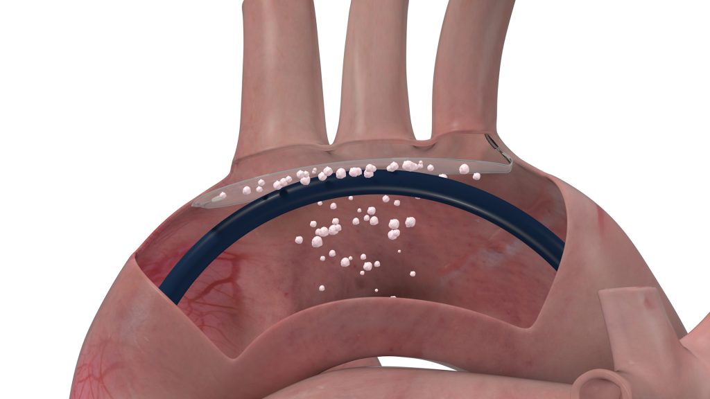 The ProtEmbo Cerebral Embolic Protection system in the Aortic Arch (Graphic: Business Wire)The ProtEmbo Cerebral Embolic Protection system in the Aortic Arch (Graphic: Business Wire)The ProtEmbo Cerebral Embolic Protection system in the Aortic Arch (Graphic: Business Wire)The ProtEmbo Cerebral Embolic Protection system in the Aortic Arch (Graphic: Business Wire)The ProtEmbo Cerebral Embolic Protection system in the Aortic Arch (Graphic: Business Wire)The ProtEmbo Cerebral Embolic Protection system in the Aortic Arch (Graphic: Business Wire)The ProtEmbo Cerebral Embolic Protection system in the Aortic Arch (Graphic: Business Wire)